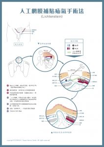 Lichtenstein-mesh 人工網膜補貼疝氣手術法