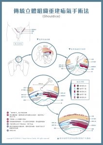 Shouldice-surgery 傳統立體組織重建疝氣手術