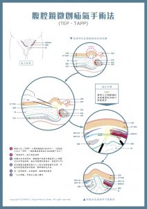 TEP-TAPP 腹腔鏡微創疝氣手術法