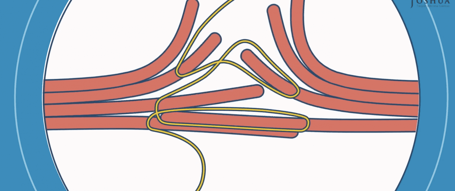 integrative-hernioplasty
