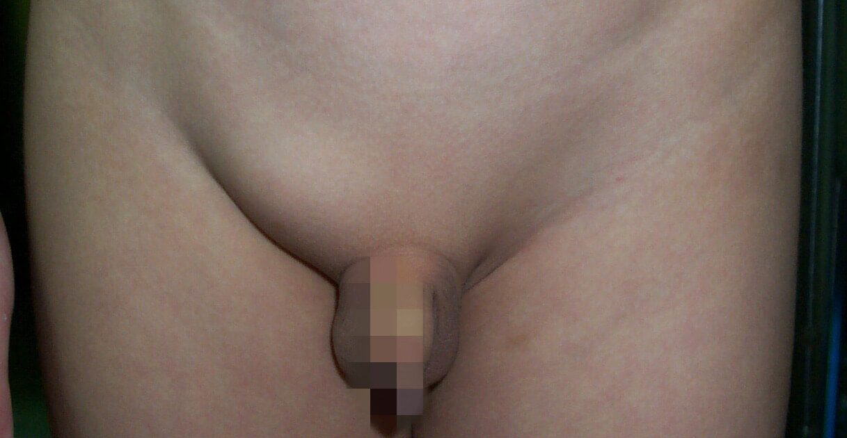 男性兒童(小兒)疝氣