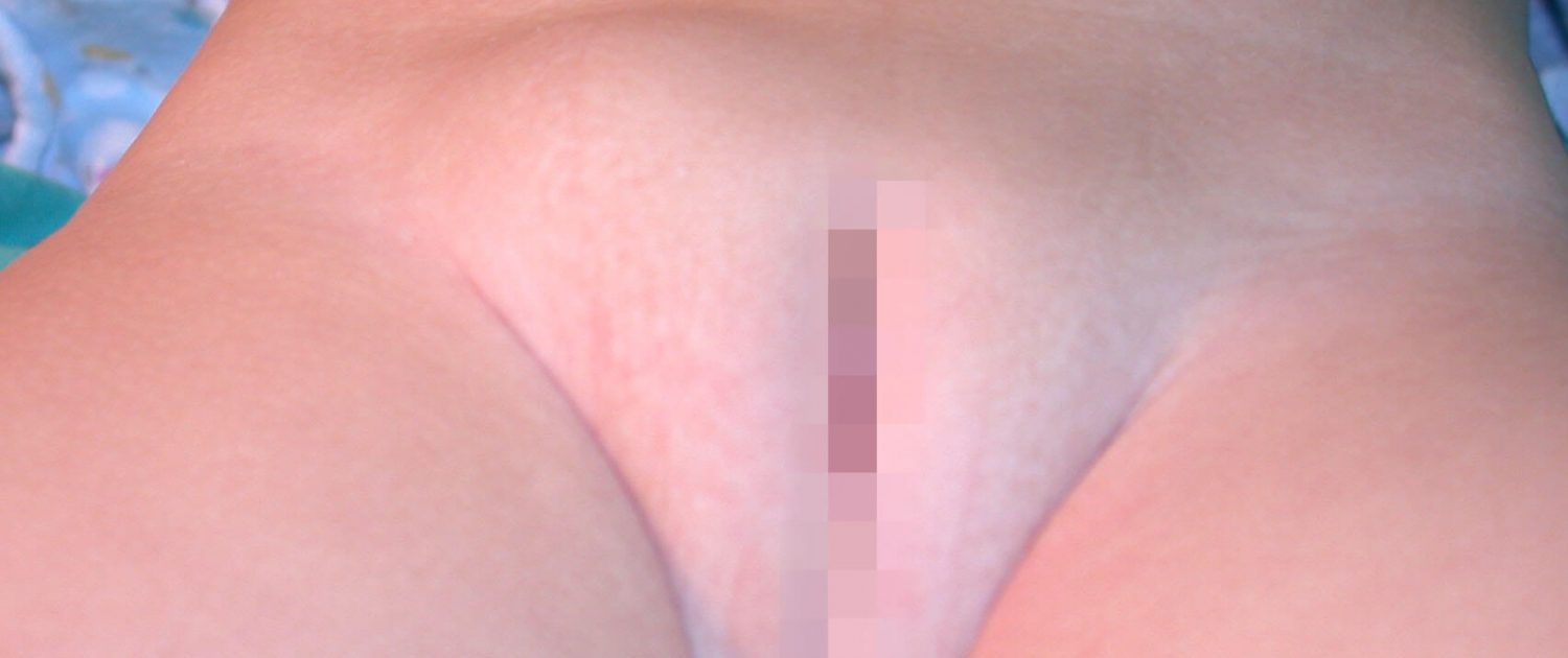 女性兒童(小兒)疝氣
