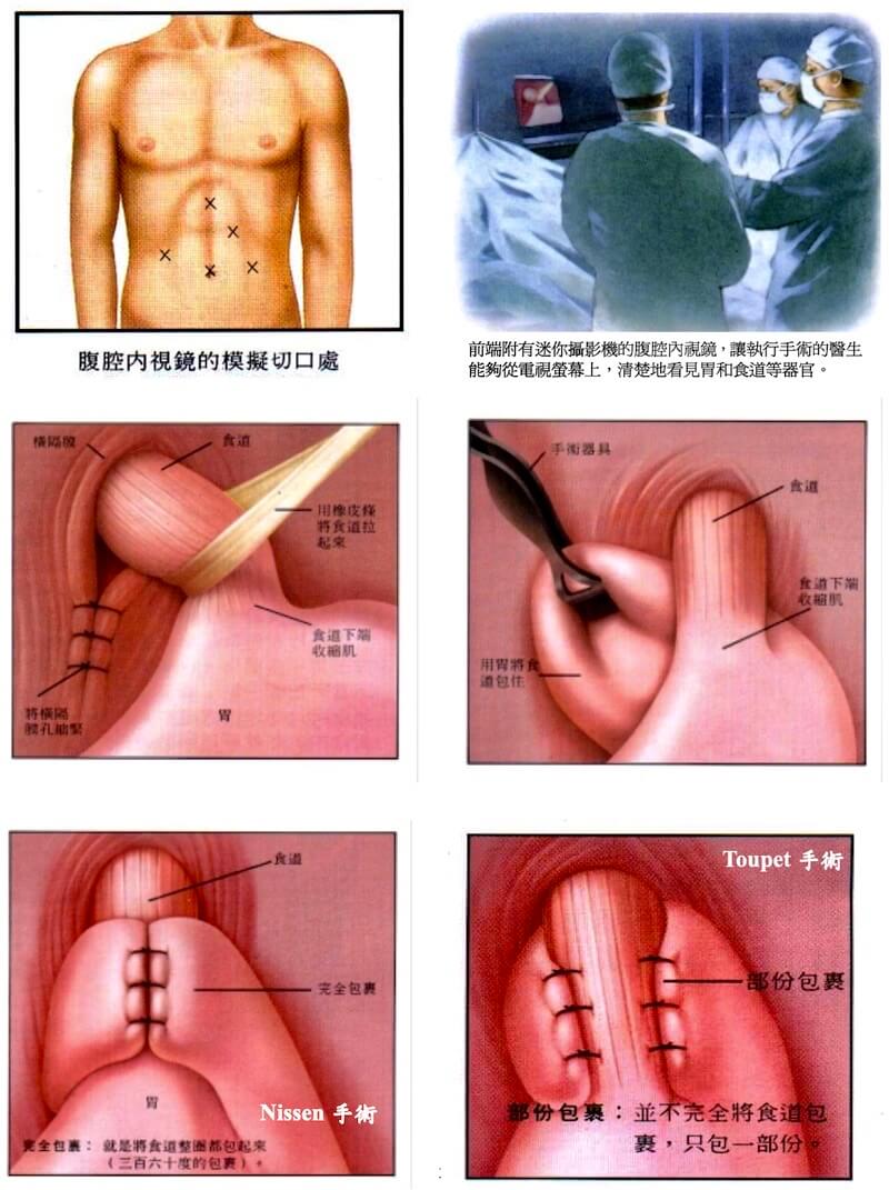 食道疝氣修補(Hiatal Hernia Repair)+胃底包埋折疊術(Nissen Fundoplication)
