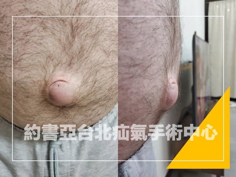 臍疝氣